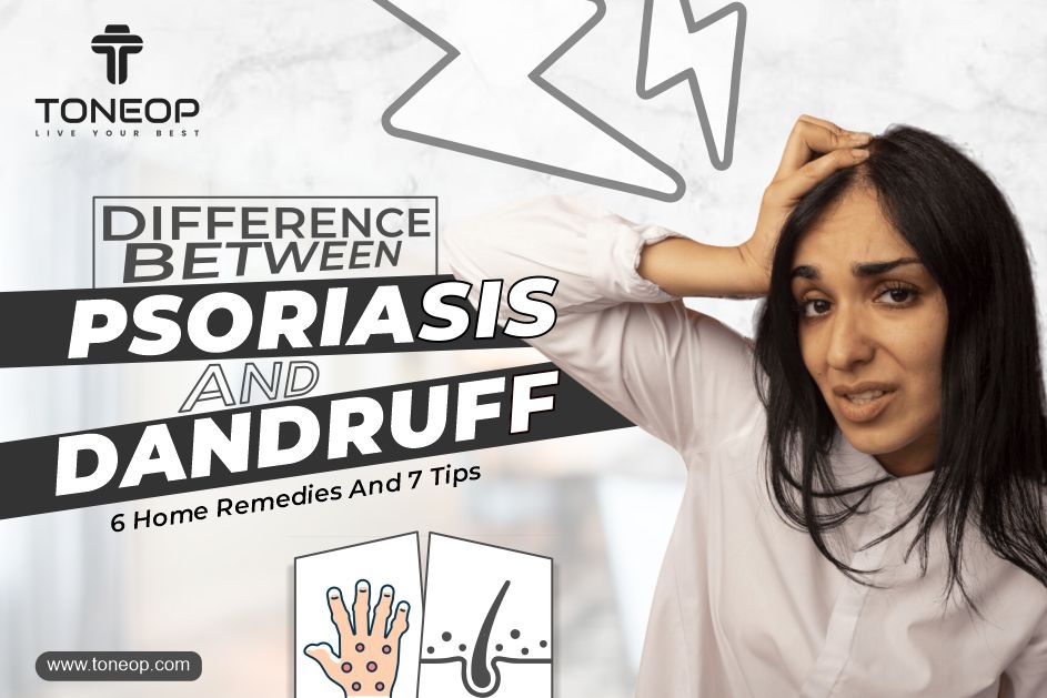 Difference Between Psoriasis And Dandruff: 6 Home Remedies And 7 Tips 