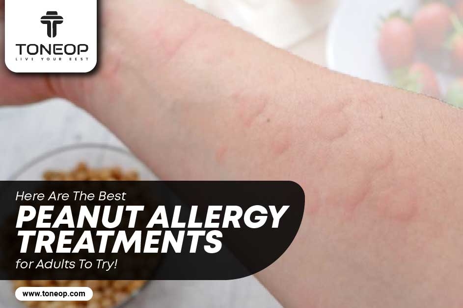 Here Are The Best Peanut allergy Treatments for Adults To Try!
