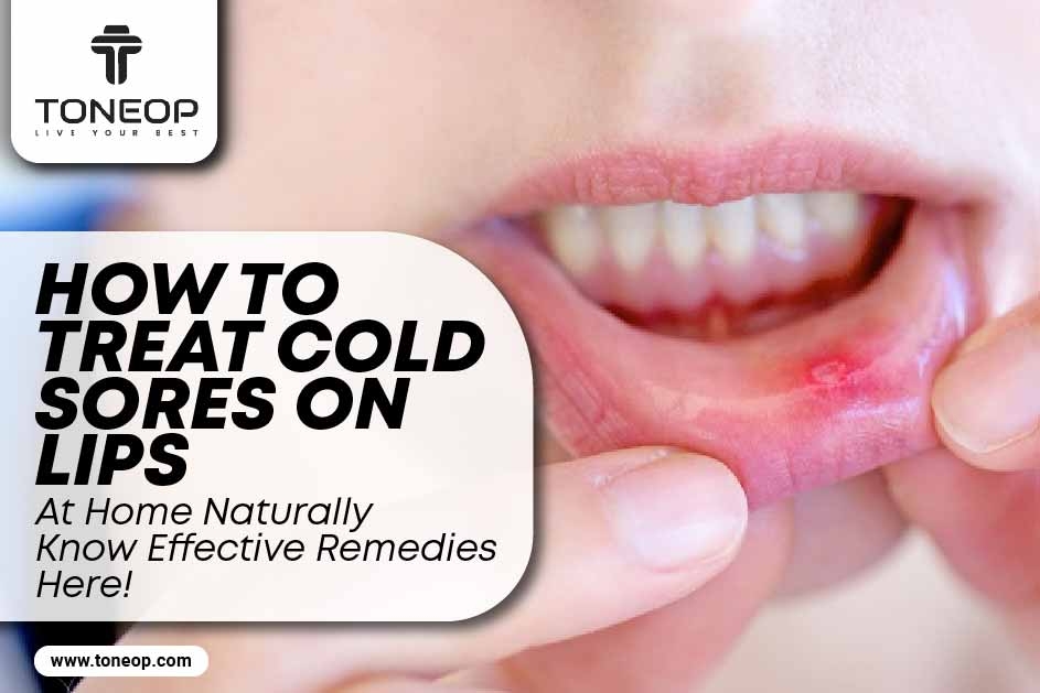 How To Treat Cold Sores On Lips At Home Naturally? Know Effective Remedies Here! 