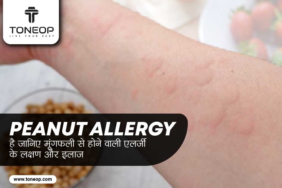 Peanut allergy है? जानिए मूंगफली से होने वाली एलर्जी के लक्षण और इलाज