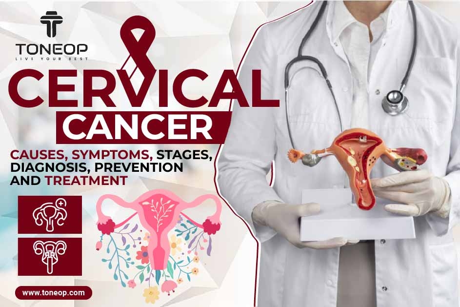 Cervical Cancer: Causes, Symptoms, Stages, Diagnosis, Prevention And Treatment