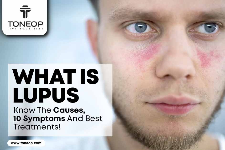 What Is Lupus? Know The Causes, 10 Symptoms And Best Treatments! 