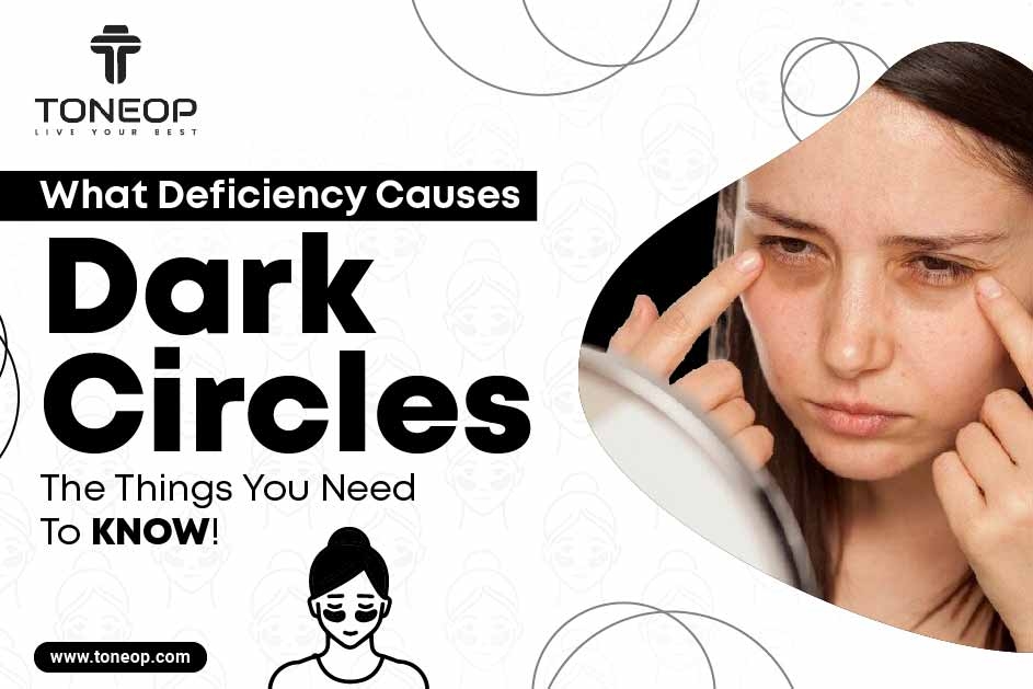 What Deficiency Causes Dark Circles? The Things You Need To Know!