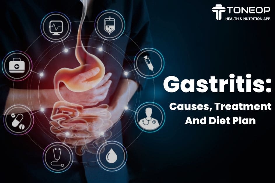 Gastritis: Causes, Treatment And Diet Plan