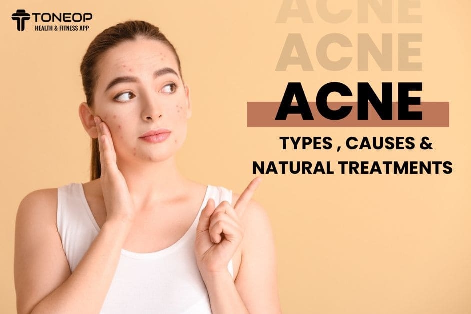 Acne: Types, Causes And Natural Treatments